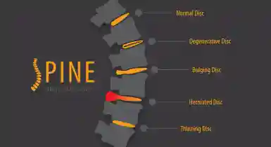 Patient Lucy Testimonial – Herniated Disc