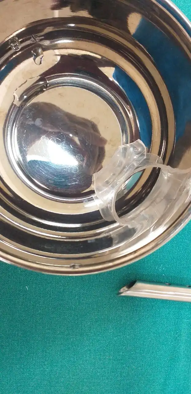 Wockhardt Doctors Remove 1.5 Inch Bottle Cap Stuck In An Infant’s Throat