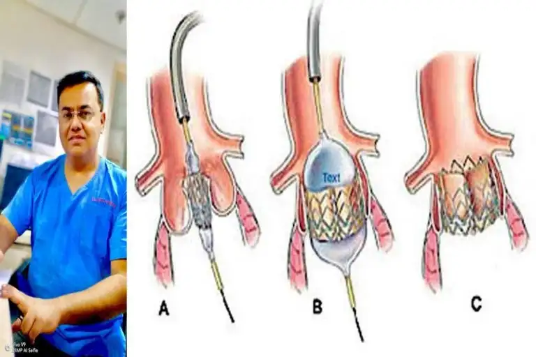 Heart Valve replacement needs no surgery now, First case of TAVI performed at Wockhardt Hospitals, Nagpur