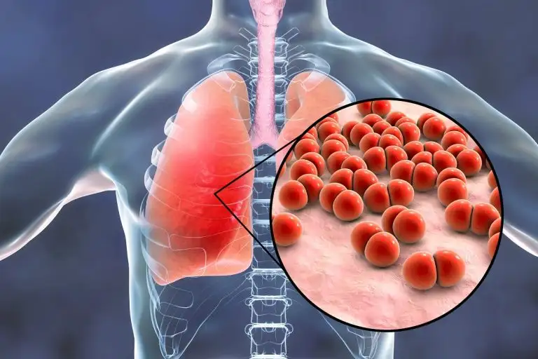 An expert explains why covid-19 pneumonia can be deadly in many ways