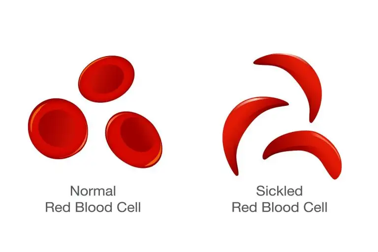 Sickle Cell Disease