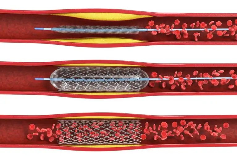 Patient with Three 100% Artery Blockages Treated by Angioplasty