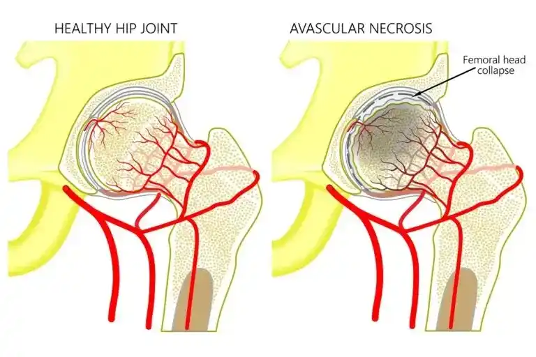 Avascular Necrosis of the Femoral Head (AVN) Among Youngsters