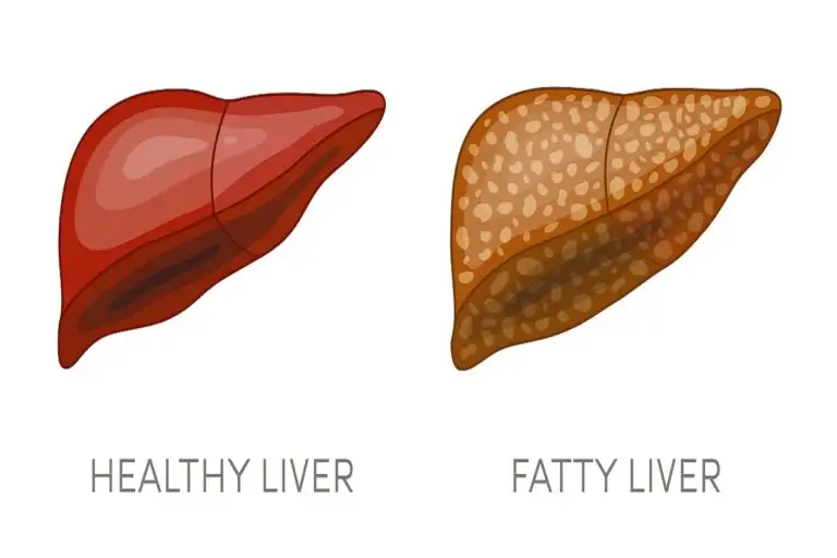 What is Non-Alcoholic Fatty Liver On The Rise Among Young Adults?