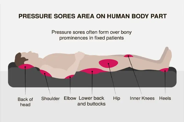 Pressure Ulcers (Bed Sore) Kills Patients