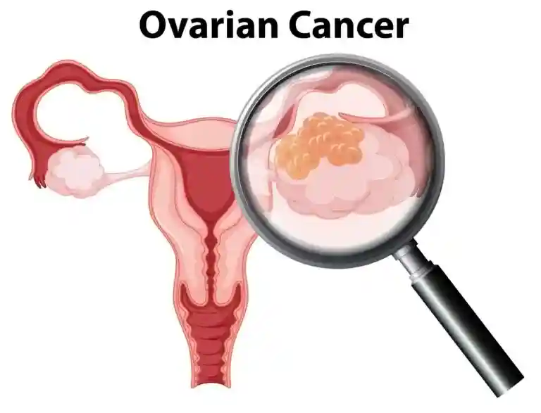 Ovarian Cancer Leads to Fluid Buildup in Lower Abdomen