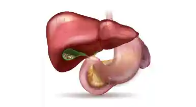 Gallstones