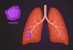 Lung Tumour