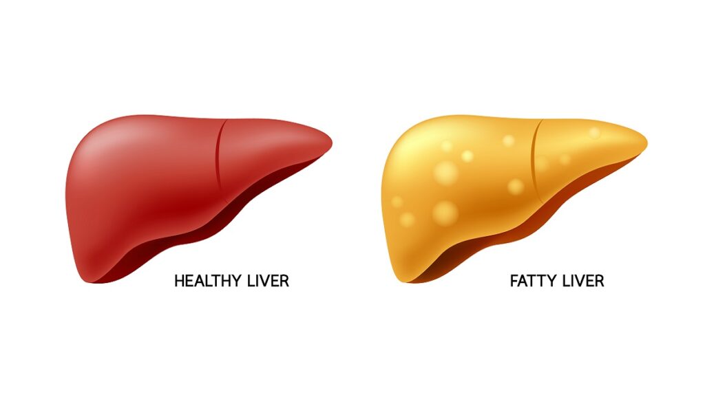 The Four Stages Of Fatty Liver Disease Explained Wockhardt Hospitals