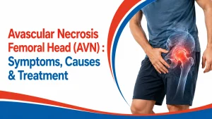 avascular necrosis of femoral head